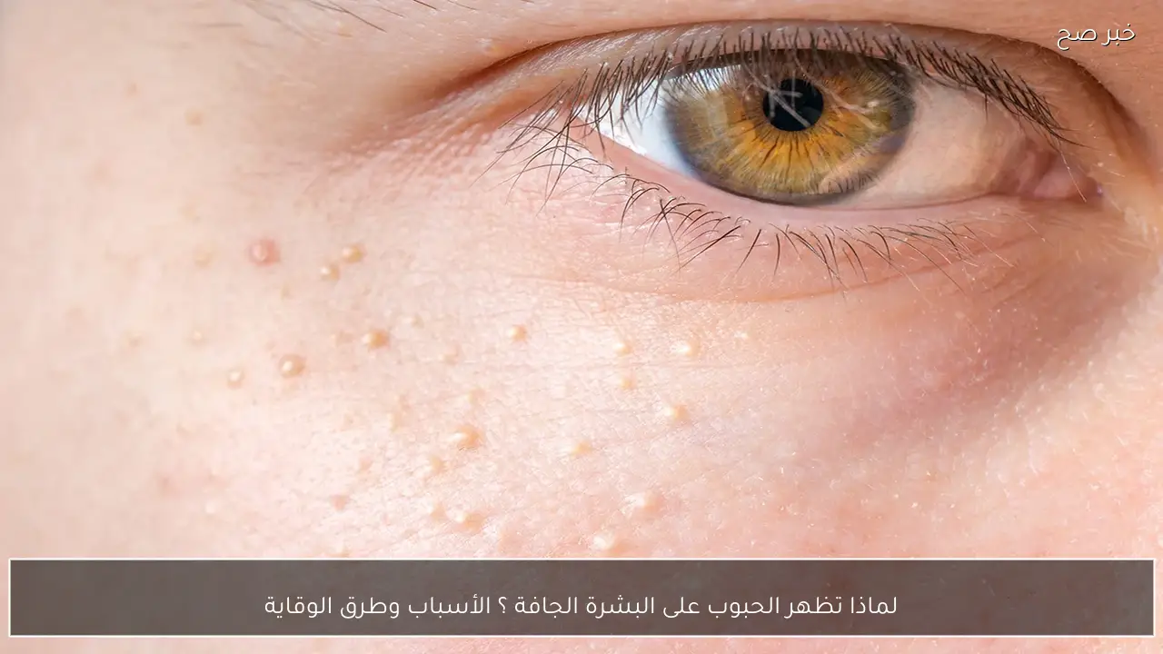 لماذا تظهر الحبوب على البشرة الجافة ؟ الأسباب وطرق الوقاية